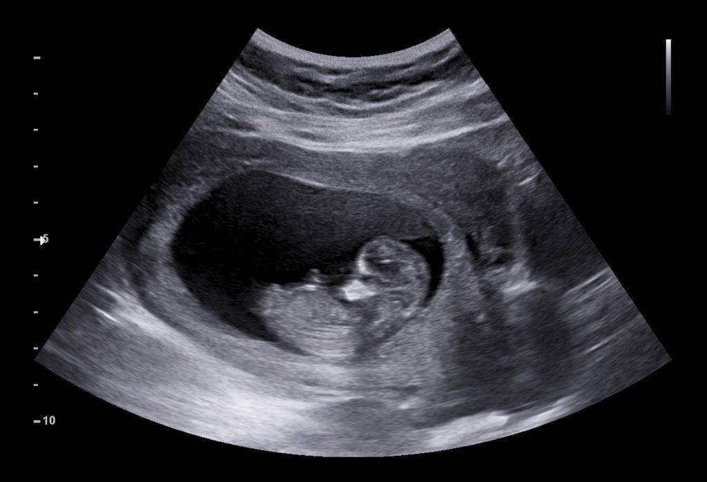 ULTRA SOUND